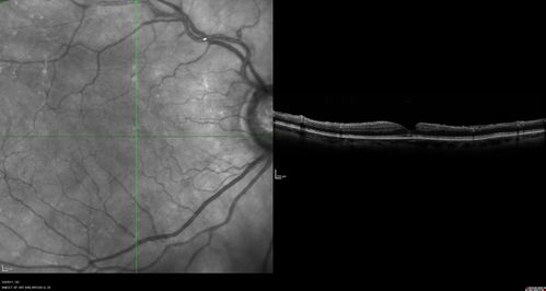 Branch Retinal Arterial Occlusion Right Eye - Atheromata - Both Eyes
83 year old woman with no symptoms - VA 20/40 in both eyes.  Right eye has ST BRAO with silver wiring.  Left eye has superotemporal atheromata
