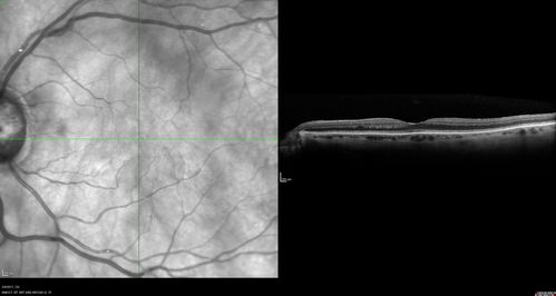 Branch Retinal Arterial Occlusion Right Eye - Atheromata - Both Eyes
83 year old woman with no symptoms - VA 20/40 in both eyes.  Right eye has ST BRAO with silver wiring.  Left eye has superotemporal atheromata
