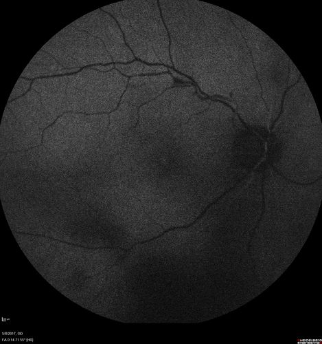 Branch Retinal Arterial Occlusion Right Eye - Atheromata - Both Eyes
83 year old woman with no symptoms - VA 20/40 in both eyes.  Right eye has ST BRAO with silver wiring.  Left eye has superotemporal atheromata
