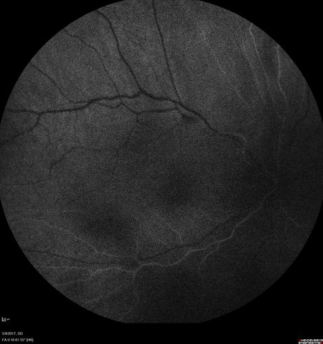 Branch Retinal Arterial Occlusion Right Eye - Atheromata - Both Eyes
83 year old woman with no symptoms - VA 20/40 in both eyes.  Right eye has ST BRAO with silver wiring.  Left eye has superotemporal atheromata
