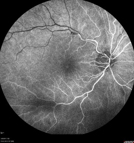 Branch Retinal Arterial Occlusion Right Eye - Atheromata - Both Eyes
83 year old woman with no symptoms - VA 20/40 in both eyes.  Right eye has ST BRAO with silver wiring.  Left eye has superotemporal atheromata
