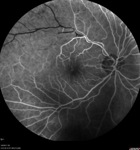 Branch Retinal Arterial Occlusion Right Eye - Atheromata - Both Eyes
83 year old woman with no symptoms - VA 20/40 in both eyes.  Right eye has ST BRAO with silver wiring.  Left eye has superotemporal atheromata
