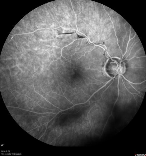 Branch Retinal Arterial Occlusion Right Eye - Atheromata - Both Eyes
83 year old woman with no symptoms - VA 20/40 in both eyes.  Right eye has ST BRAO with silver wiring.  Left eye has superotemporal atheromata
