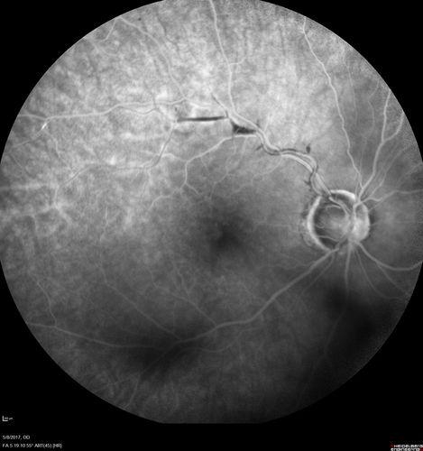 Branch Retinal Arterial Occlusion Right Eye - Atheromata - Both Eyes
83 year old woman with no symptoms - VA 20/40 in both eyes.  Right eye has ST BRAO with silver wiring.  Left eye has superotemporal atheromata

