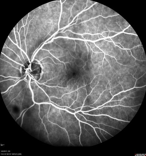 Branch Retinal Arterial Occlusion Right Eye - Atheromata - Both Eyes
83 year old woman with no symptoms - VA 20/40 in both eyes.  Right eye has ST BRAO with silver wiring.  Left eye has superotemporal atheromata
