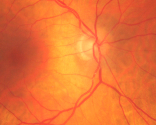 Retinal Arterial Atheromata
68-year-old woman with records going back 7 years, which clearly document retinal arterial plaques in both eyes. 
Keywords: plaque;atheromata;crystal