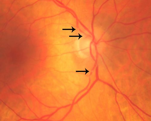 Retinal Arterial Atheromata
68-year-old woman with records going back 7 years, which clearly document retinal arterial plaques in both eyes. 
Keywords: plaque;atheromata;crystal