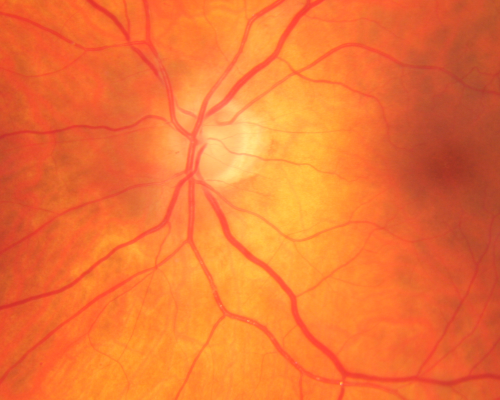 Retinal Arterial Atheromata
68-year-old woman with records going back 7 years, which clearly document retinal arterial plaques in both eyes. 
Schlüsselwörter: plaque;atheromata;crystal