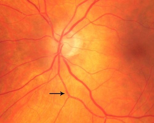 Retinal Arterial Atheromata
68-year-old woman with records going back 7 years, which clearly document retinal arterial plaques in both eyes. 
Keywords: plaque;atheromata;crystal