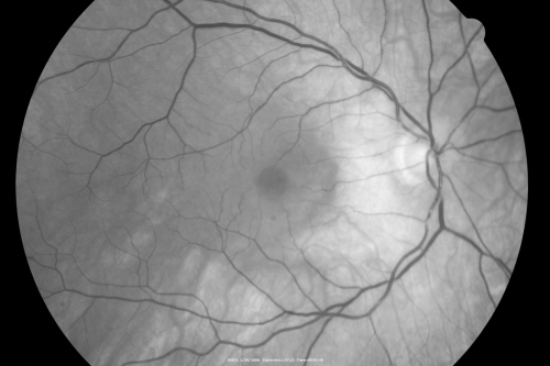 Retinal Arterial Atheromata
68-year-old woman with records going back 7 years, which clearly document retinal arterial plaques in both eyes. 
Schlüsselwörter: plaque;atheromata;crystal