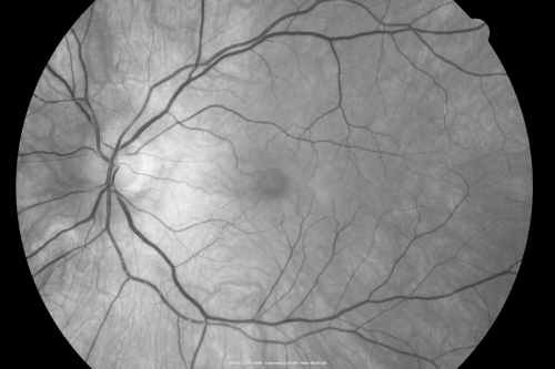 Retinal Arterial Atheromata
68-year-old woman with records going back 7 years, which clearly document retinal arterial plaques in both eyes. 
Keywords: plaque;atheromata;crystal