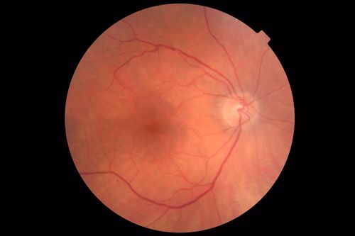 Autoimmune Retinopathy
91 year old female with severe vision loss over the past 3 years.  She has shimmery scotomas.  The main findings are outer retinal atrophy evident on OCT and FAF.  VA 20/80 OD and 20/125 OS
