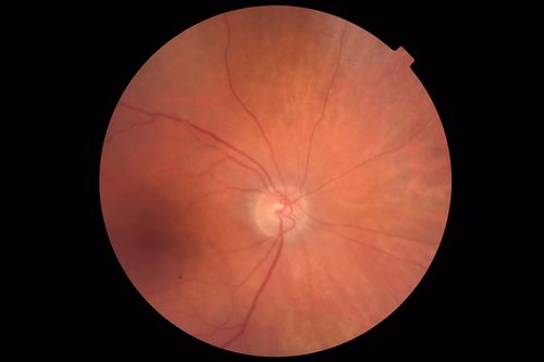 Autoimmune Retinopathy
91 year old female with severe vision loss over the past 3 years.  She has shimmery scotomas.  The main findings are outer retinal atrophy evident on OCT and FAF.  VA 20/80 OD and 20/125 OS
