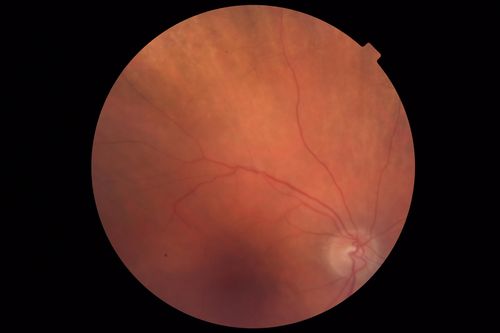Autoimmune Retinopathy
91 year old female with severe vision loss over the past 3 years.  She has shimmery scotomas.  The main findings are outer retinal atrophy evident on OCT and FAF.  VA 20/80 OD and 20/125 OS
