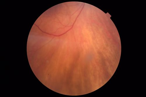 Autoimmune Retinopathy
91 year old female with severe vision loss over the past 3 years.  She has shimmery scotomas.  The main findings are outer retinal atrophy evident on OCT and FAF.  VA 20/80 OD and 20/125 OS
