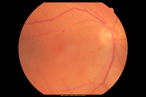 Chronic Central Serous Chorioretinopathy
77 year old man was seen at uveitis clinic and tested positive to  Anti-retinal antibody against 35 kDa and anti-optic nerve antibody.  He did not have EDI OCT, FAF, or ICG.  All testing was consistent with Chronic CSR.  His immunosuppresives were stopped and he did fine for 3 years.
