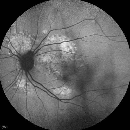 Chronic Central Serous Chorioretinopathy
77 year old man was seen at uveitis clinic and tested positive to  Anti-retinal antibody against 35 kDa and anti-optic nerve antibody.  He did not have EDI OCT, FAF, or ICG.  All testing was consistent with Chronic CSR.  His immunosuppresives were stopped and he did fine for 3 years.
