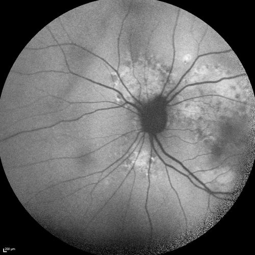 Chronic Central Serous Chorioretinopathy
77 year old man was seen at uveitis clinic and tested positive to  Anti-retinal antibody against 35 kDa and anti-optic nerve antibody.  He did not have EDI OCT, FAF, or ICG.  All testing was consistent with Chronic CSR.  His immunosuppresives were stopped and he did fine for 3 years.
