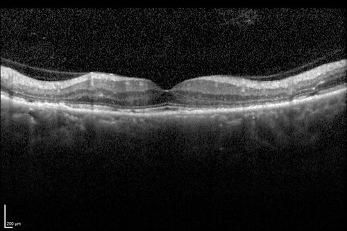 Chronic Central Serous Chorioretinopathy
77 year old man was seen at uveitis clinic and tested positive to  Anti-retinal antibody against 35 kDa and anti-optic nerve antibody.  He did not have EDI OCT, FAF, or ICG.  All testing was consistent with Chronic CSR.  His immunosuppresives were stopped and he did fine for 3 years.
