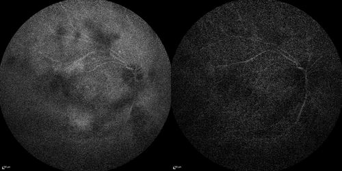 Chronic Central Serous Chorioretinopathy
77 year old man was seen at uveitis clinic and tested positive to  Anti-retinal antibody against 35 kDa and anti-optic nerve antibody.  He did not have EDI OCT, FAF, or ICG.  All testing was consistent with Chronic CSR.  His immunosuppresives were stopped and he did fine for 3 years.
