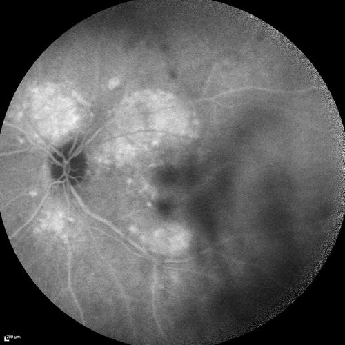 Chronic Central Serous Chorioretinopathy
77 year old man was seen at uveitis clinic and tested positive to  Anti-retinal antibody against 35 kDa and anti-optic nerve antibody.  He did not have EDI OCT, FAF, or ICG.  All testing was consistent with Chronic CSR.  His immunosuppresives were stopped and he did fine for 3 years.
