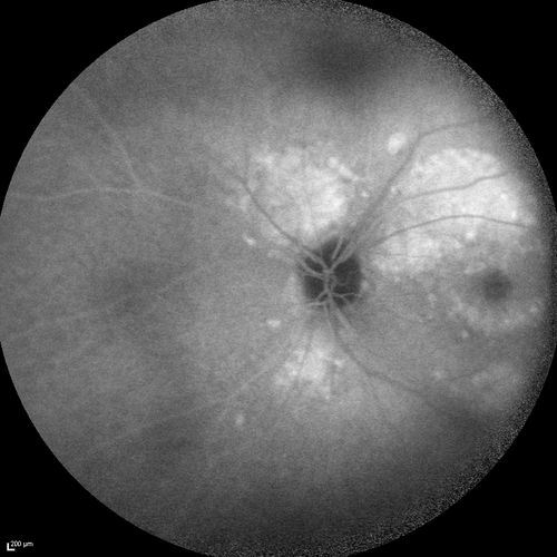 Chronic Central Serous Chorioretinopathy
77 year old man was seen at uveitis clinic and tested positive to  Anti-retinal antibody against 35 kDa and anti-optic nerve antibody.  He did not have EDI OCT, FAF, or ICG.  All testing was consistent with Chronic CSR.  His immunosuppresives were stopped and he did fine for 3 years.

