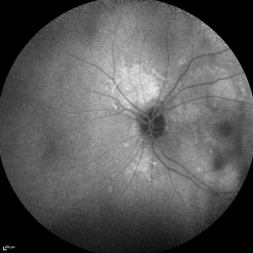 Chronic Central Serous Chorioretinopathy
77 year old man was seen at uveitis clinic and tested positive to  Anti-retinal antibody against 35 kDa and anti-optic nerve antibody.  He did not have EDI OCT, FAF, or ICG.  All testing was consistent with Chronic CSR.  His immunosuppresives were stopped and he did fine for 3 years.
