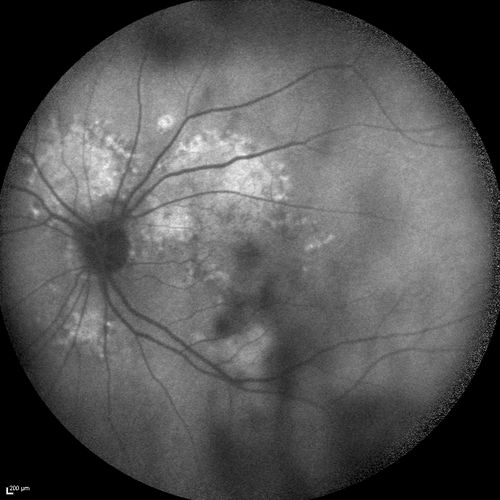 Chronic Central Serous Chorioretinopathy
77 year old man was seen at uveitis clinic and tested positive to  Anti-retinal antibody against 35 kDa and anti-optic nerve antibody.  He did not have EDI OCT, FAF, or ICG.  All testing was consistent with Chronic CSR.  His immunosuppresives were stopped and he did fine for 3 years.
