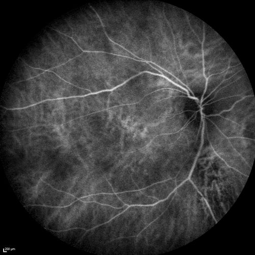 Chronic Central Serous Chorioretinopathy
77 year old man was seen at uveitis clinic and tested positive to  Anti-retinal antibody against 35 kDa and anti-optic nerve antibody.  He did not have EDI OCT, FAF, or ICG.  All testing was consistent with Chronic CSR.  His immunosuppresives were stopped and he did fine for 3 years.
