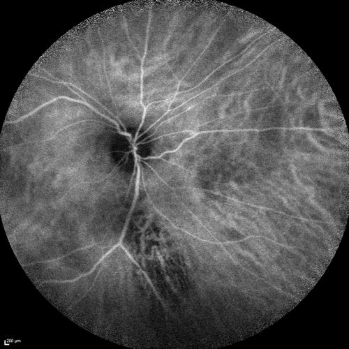 Chronic Central Serous Chorioretinopathy
77 year old man was seen at uveitis clinic and tested positive to  Anti-retinal antibody against 35 kDa and anti-optic nerve antibody.  He did not have EDI OCT, FAF, or ICG.  All testing was consistent with Chronic CSR.  His immunosuppresives were stopped and he did fine for 3 years.
