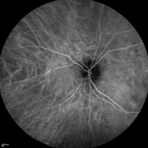 Chronic Central Serous Chorioretinopathy
77 year old man was seen at uveitis clinic and tested positive to  Anti-retinal antibody against 35 kDa and anti-optic nerve antibody.  He did not have EDI OCT, FAF, or ICG.  All testing was consistent with Chronic CSR.  His immunosuppresives were stopped and he did fine for 3 years.
