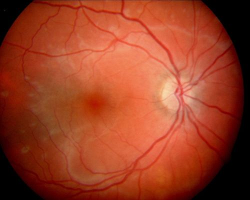 Acute Annular Outer Retinopathy - VA loss 2 days Right Eye Only - 25 Year Old Woman- AZOOR - White Line Around Fresh Lesions
Initial visit (June 11, 2011): 2 days of vision loss right eye.  Wedge suddenly of VA loss OD, too dardkto see through.  No flashes or floaters.  VA 20/20 OU.


