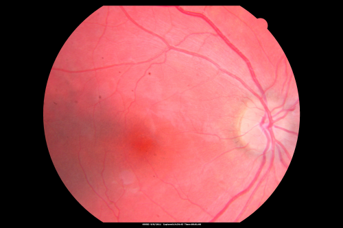 Acute Annular Outer Retinopathy for 3 Months - 25 YO Female   Fundus Photograph
25-year-old female who, about three months ago, put on her sunglasses and noticed a smudge in the vision and at that point she noticed the right eye was hazy. She had a cold a week or two before the vision loss, but she didnâ€™t have any fever.  She has no focal neurological problems in her past history.  VA 20/20 OU
