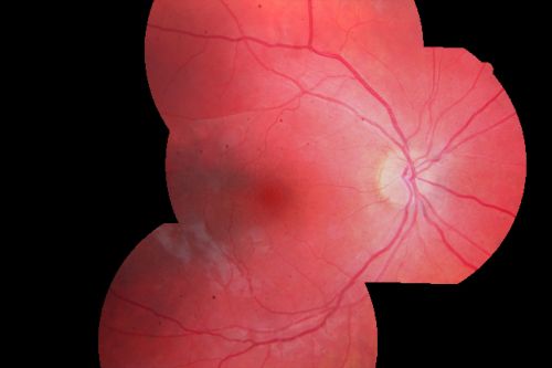 Acute Annular Outer Retinopathy for 3 Months - 25 YO Female   Fundus Photograph
25-year-old female who, about three months ago, put on her sunglasses and noticed a smudge in the vision and at that point she noticed the right eye was hazy. She had a cold a week or two before the vision loss, but she didnâ€™t have any fever.  She has no focal neurological problems in her past history.  VA 20/20 OU
