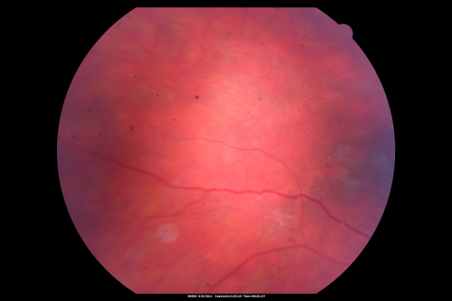 Acute Annular Outer Retinopathy for 3 Months - 25 YO Female   Fundus Photograph
25-year-old female who, about three months ago, put on her sunglasses and noticed a smudge in the vision and at that point she noticed the right eye was hazy. She had a cold a week or two before the vision loss, but she didnâ€™t have any fever.  She has no focal neurological problems in her past history.  VA 20/20 OU
