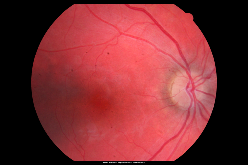 Acute Annular Outer Retinopathy for 3 Months - 25 YO Female   Fundus Photograph
25-year-old female who, about three months ago, put on her sunglasses and noticed a smudge in the vision and at that point she noticed the right eye was hazy. She had a cold a week or two before the vision loss, but she didnâ€™t have any fever.  She has no focal neurological problems in her past history.  VA 20/20 OU
