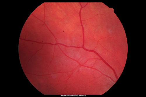 Acute Annular Outer Retinopathy for 3 Months - 25 YO Female   Fundus Photograph
25-year-old female who, about three months ago, put on her sunglasses and noticed a smudge in the vision and at that point she noticed the right eye was hazy. She had a cold a week or two before the vision loss, but she didnâ€™t have any fever.  She has no focal neurological problems in her past history.  VA 20/20 OU
