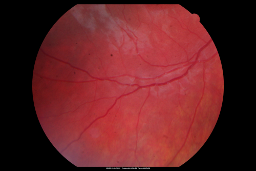 Acute Annular Outer Retinopathy for 3 Months - 25 YO Female   Fundus Photograph
25-year-old female who, about three months ago, put on her sunglasses and noticed a smudge in the vision and at that point she noticed the right eye was hazy. She had a cold a week or two before the vision loss, but she didnâ€™t have any fever.  She has no focal neurological problems in her past history.  VA 20/20 OU
