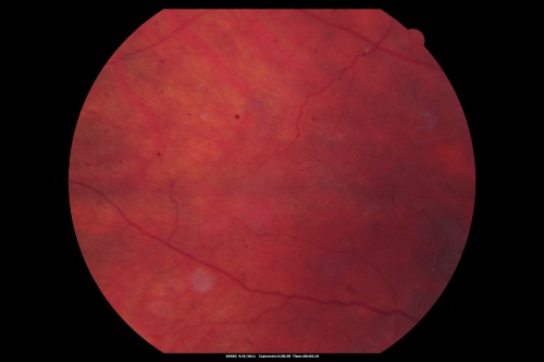 Acute Annular Outer Retinopathy for 3 Months - 25 YO Female  Fundus Photograph
25-year-old female who, about three months ago, put on her sunglasses and noticed a smudge in the vision and at that point she noticed the right eye was hazy. She had a cold a week or two before the vision loss, but she didnâ€™t have any fever.  She has no focal neurological problems in her past history.  VA 20/20 OU
