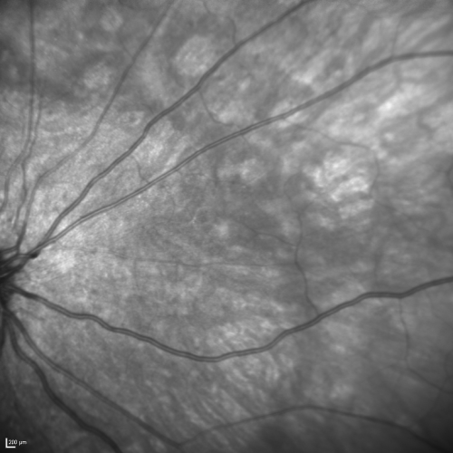 Acute Annular Outer Retinopathy for 3 Months - 25 YO Female   InfraRed Image
25-year-old female who, about three months ago, put on her sunglasses and noticed a smudge in the vision and at that point she noticed the right eye was hazy. She had a cold a week or two before the vision loss, but she didnâ€™t have any fever.  She has no focal neurological problems in her past history.  VA 20/20 OU
