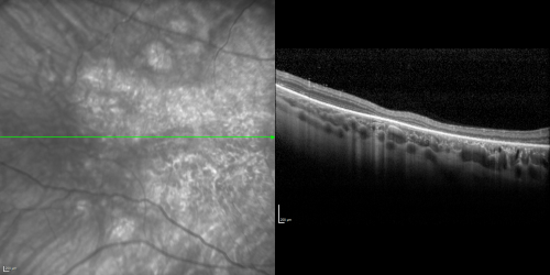 Acute Annular Outer Retinopathy for 3 Months - 25 YO Female   Spectral Domain Optical Coherence Tomgraphy
25-year-old female who, about three months ago, put on her sunglasses and noticed a smudge in the vision and at that point she noticed the right eye was hazy. She had a cold a week or two before the vision loss, but she didnâ€™t have any fever.  She has no focal neurological problems in her past history.  VA 20/20 OU
