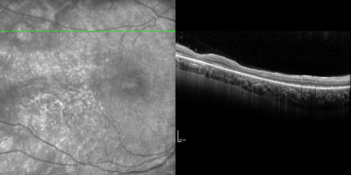 Acute Annular Outer Retinopathy for 3 Months - 25 YO Female   Spectral Domain Optical Coherence Tomgraphy
25-year-old female who, about three months ago, put on her sunglasses and noticed a smudge in the vision and at that point she noticed the right eye was hazy. She had a cold a week or two before the vision loss, but she didnâ€™t have any fever.  She has no focal neurological problems in her past history.  VA 20/20 OU
