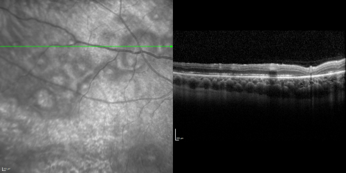 Acute Annular Outer Retinopathy for 3 Months - 25 YO Female   Spectral Domain Optical Coherence Tomgraphy
25-year-old female who, about three months ago, put on her sunglasses and noticed a smudge in the vision and at that point she noticed the right eye was hazy. She had a cold a week or two before the vision loss, but she didnâ€™t have any fever.  She has no focal neurological problems in her past history.  VA 20/20 OU
