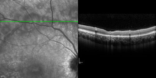 Acute Annular Outer Retinopathy for 3 Months - 25 YO Female   Spectral Domain Optical Coherence Tomgraphy
25-year-old female who, about three months ago, put on her sunglasses and noticed a smudge in the vision and at that point she noticed the right eye was hazy. She had a cold a week or two before the vision loss, but she didnâ€™t have any fever.  She has no focal neurological problems in her past history.  VA 20/20 OU
