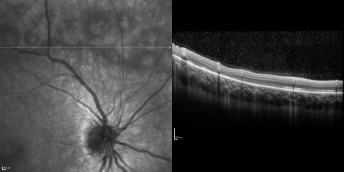 Acute Annular Outer Retinopathy for 3 Months - 25 YO Female   Spectral Domain Optical Coherence Tomgraphy
25-year-old female who, about three months ago, put on her sunglasses and noticed a smudge in the vision and at that point she noticed the right eye was hazy. She had a cold a week or two before the vision loss, but she didnâ€™t have any fever.  She has no focal neurological problems in her past history.  VA 20/20 OU
