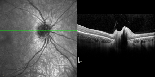 Acute Annular Outer Retinopathy for 3 Months - 25 YO Female  Spectral Domain Optical Coherence Tomgraphy
25-year-old female who, about three months ago, put on her sunglasses and noticed a smudge in the vision and at that point she noticed the right eye was hazy. She had a cold a week or two before the vision loss, but she didnâ€™t have any fever.  She has no focal neurological problems in her past history.  VA 20/20 OU
