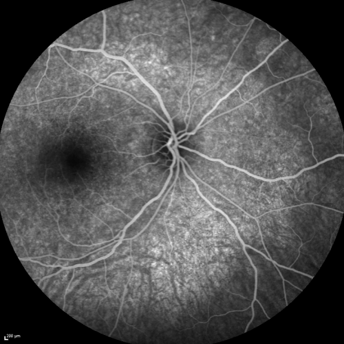 Acute Annular Outer Retinopathy for 3 Months - 25 YO Female   Fluorescein Angiogram
25-year-old female who, about three months ago, put on her sunglasses and noticed a smudge in the vision and at that point she noticed the right eye was hazy. She had a cold a week or two before the vision loss, but she didnâ€™t have any fever.  She has no focal neurological problems in her past history.  VA 20/20 OU
