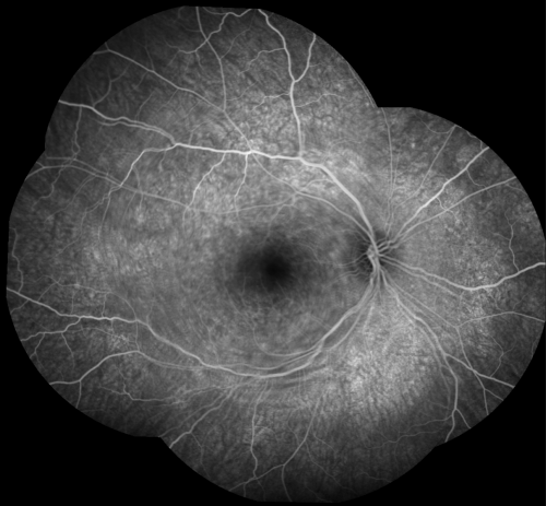 Acute Annular Outer Retinopathy for 3 Months - 25 YO Female  Fluorescein Angiogram
25-year-old female who, about three months ago, put on her sunglasses and noticed a smudge in the vision and at that point she noticed the right eye was hazy. She had a cold a week or two before the vision loss, but she didnâ€™t have any fever.  She has no focal neurological problems in her past history.  VA 20/20 OU
