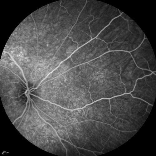 Acute Annular Outer Retinopathy for 3 Months - 25 YO Female  FA
25-year-old female who, about three months ago, put on her sunglasses and noticed a smudge in the vision and at that point she noticed the right eye was hazy. She had a cold a week or two before the vision loss, but she didnâ€™t have any fever.  She has no focal neurological problems in her past history.  VA 20/20 OU
