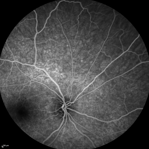 Acute Annular Outer Retinopathy for 3 Months - 25 YO Female  FA
25-year-old female who, about three months ago, put on her sunglasses and noticed a smudge in the vision and at that point she noticed the right eye was hazy. She had a cold a week or two before the vision loss, but she didnâ€™t have any fever.  She has no focal neurological problems in her past history.  VA 20/20 OU

